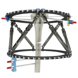 Smart Fixator® – Hexapod