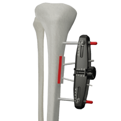 MicroLift®