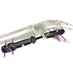 UniX® Wrist Fixator