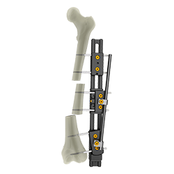 UniX® Rail Fixator