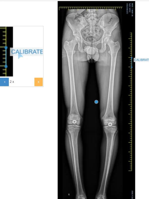 Step 1, Calibrate: Calibrate the X-ray on the ruler. The product template is drawn at the scale of the calibration.