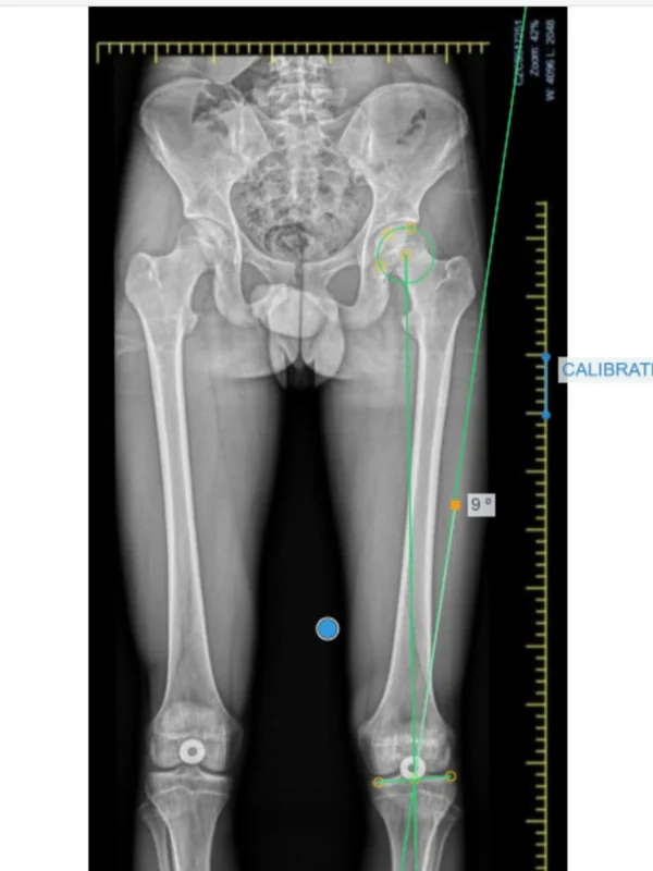 Step 2, Measure the alignment: Place the HTO or Orthoroentgenography template to see the mechanical axis.