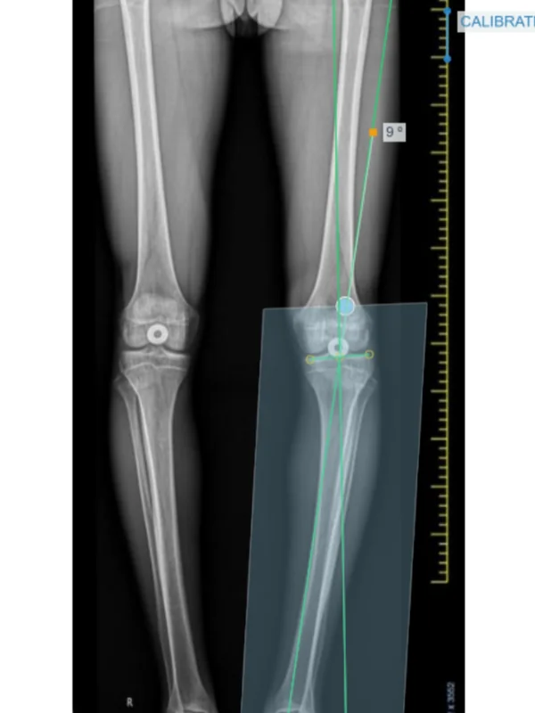 Step 3, Select the area: Cut around the proximal tibia and the leg below it, keeping the points of the template inside.