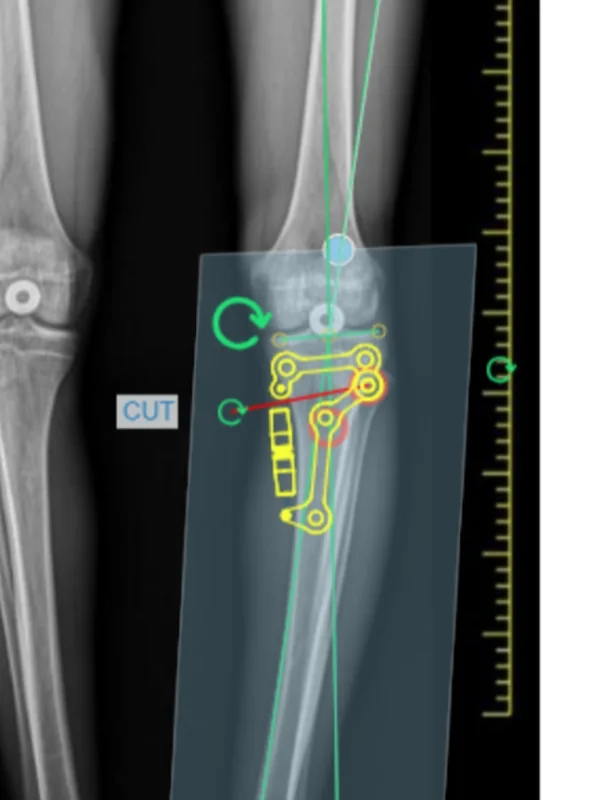 Step 5, Cut: Position the red osteotomy line and select CUT: the distal part becomes a segment of its own.