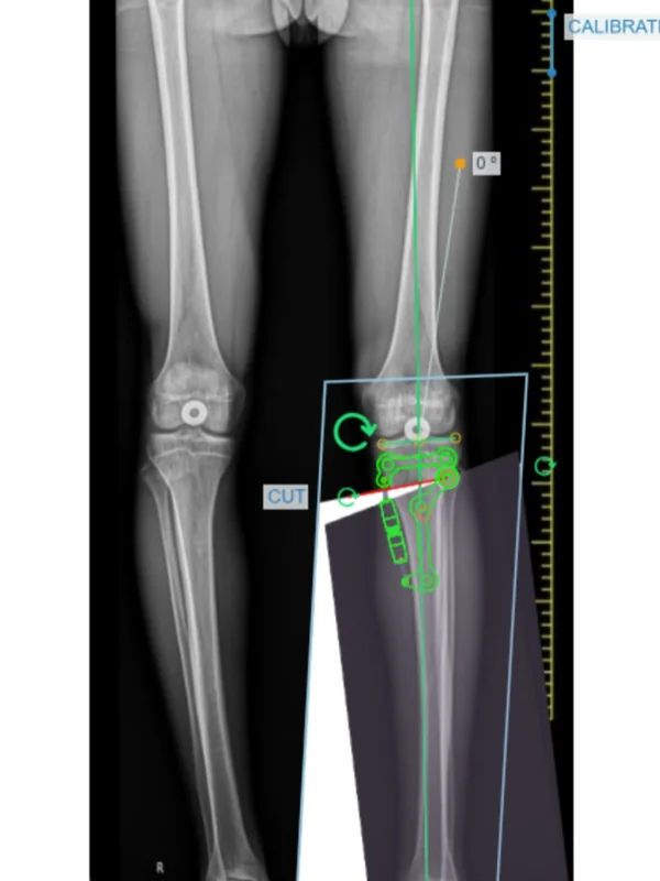 Step 6, Angulate: Angulate the distal part 1° at a time and read the new mechanical axis and the total correction.