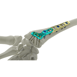 Wrist Plating System