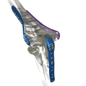 Anatomic Elbow Plates
