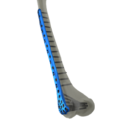 Distal Femur Locking Plate