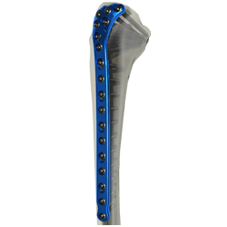 Proximal Tibia Locking Plate