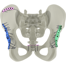Pelvic and Acetabular Plates