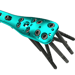 Proximal Humerus Locking Plate