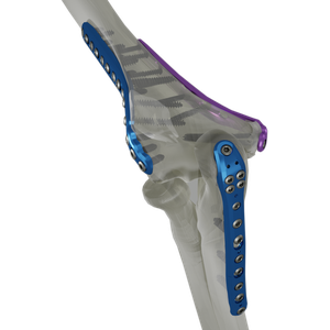 Anatomic Elbow Plates