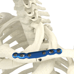 Clavicle Plating System