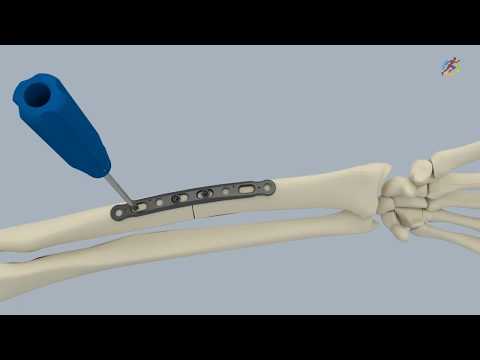 Forearm Plate System