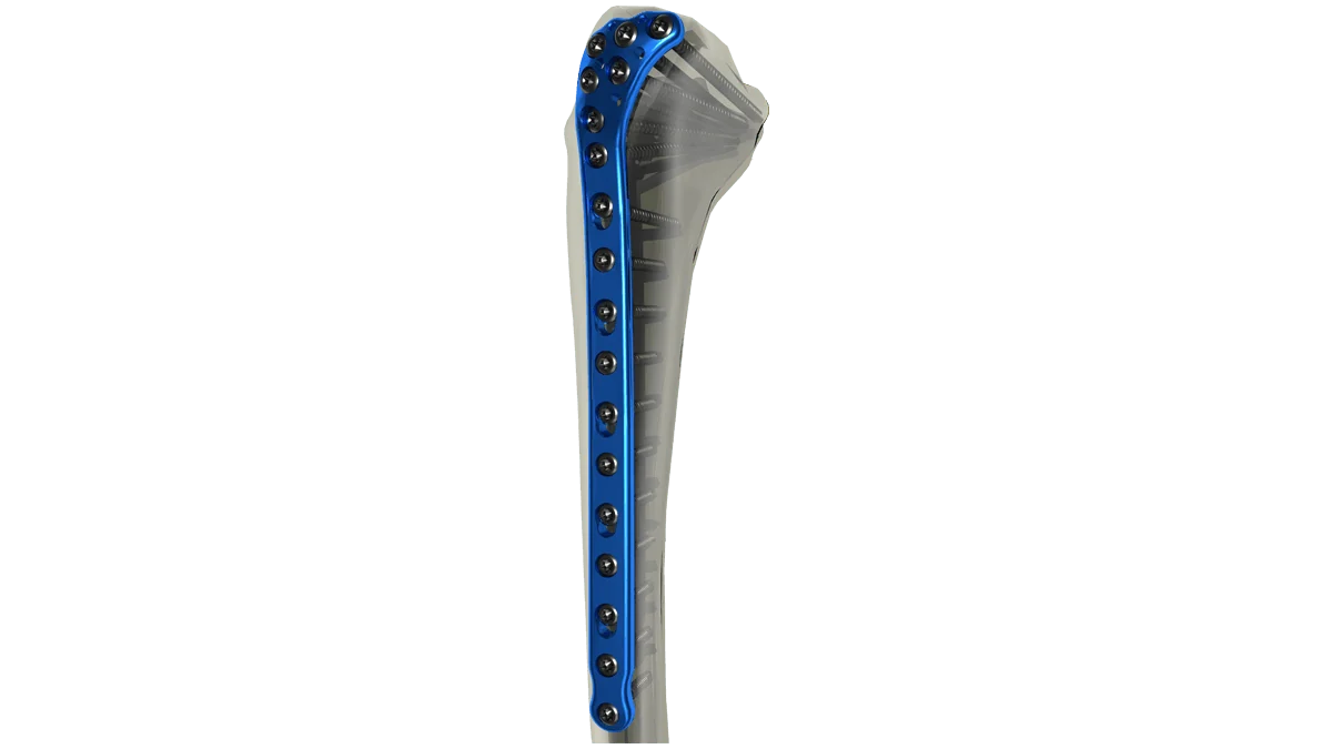 Proximal Tibia Locking Plate — view 1