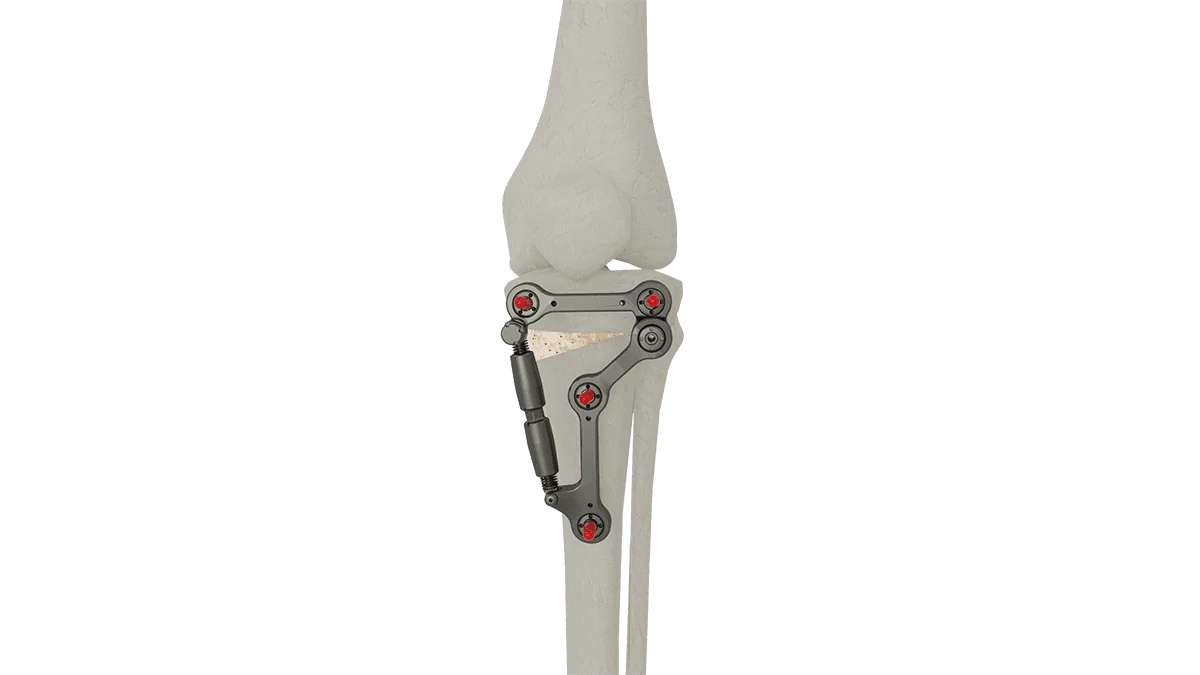 UniX® Metaphyseal Hinge Fixator — view 1
