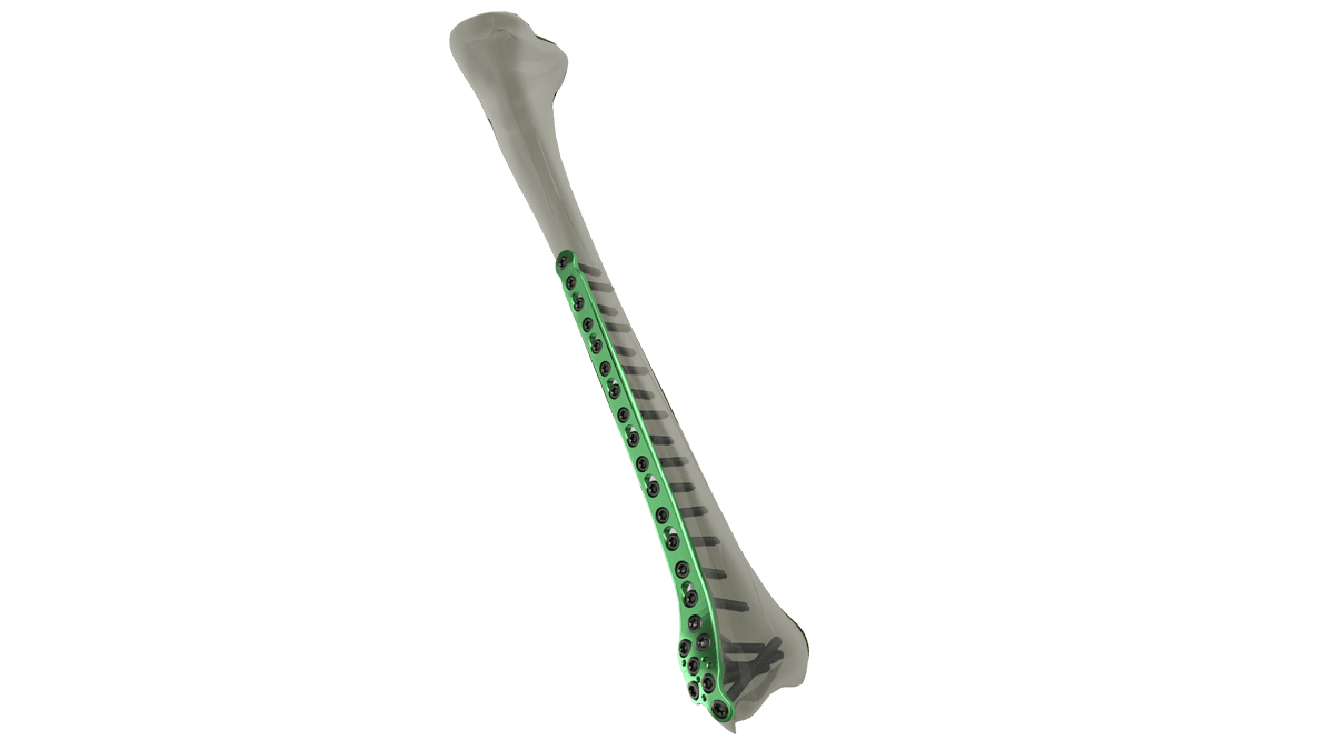 Distal Tibia Locking Plate — view 1