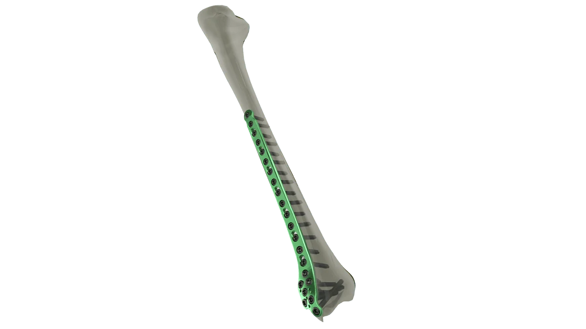 Distal Tibia Locking Plate — view 1