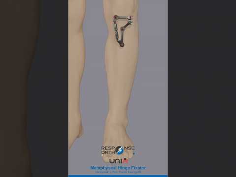 Healing in Motion: See the Difference with UniX® Metaphyseal Hinge Fixator