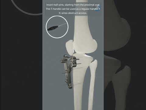 UniPlasty® - Jack it up! Precise control, better alignment...