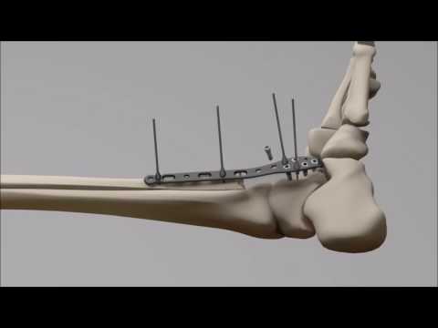 STEP™ Ankle Fracture Plating System - Fibula Plate