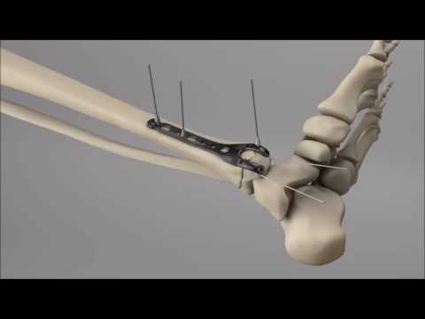 STEP™ Ankle Fracture Plating System - Medial Fork Plate