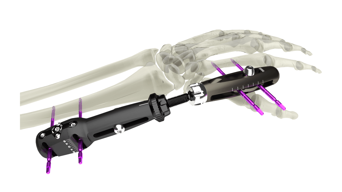UniX® Wrist Fixator — view 1