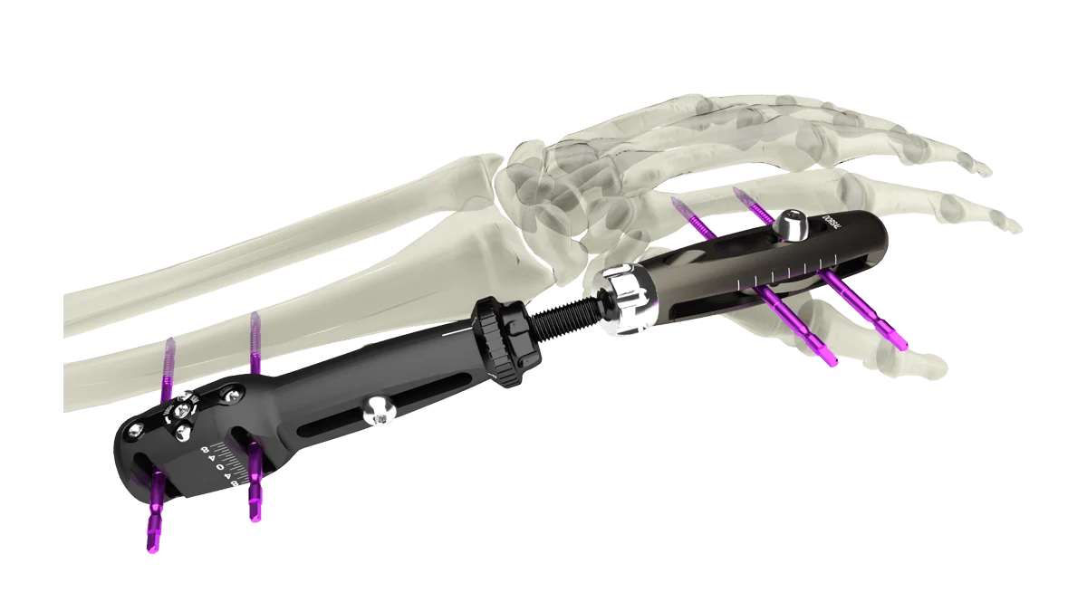 UniX® Wrist Fixator — view 1