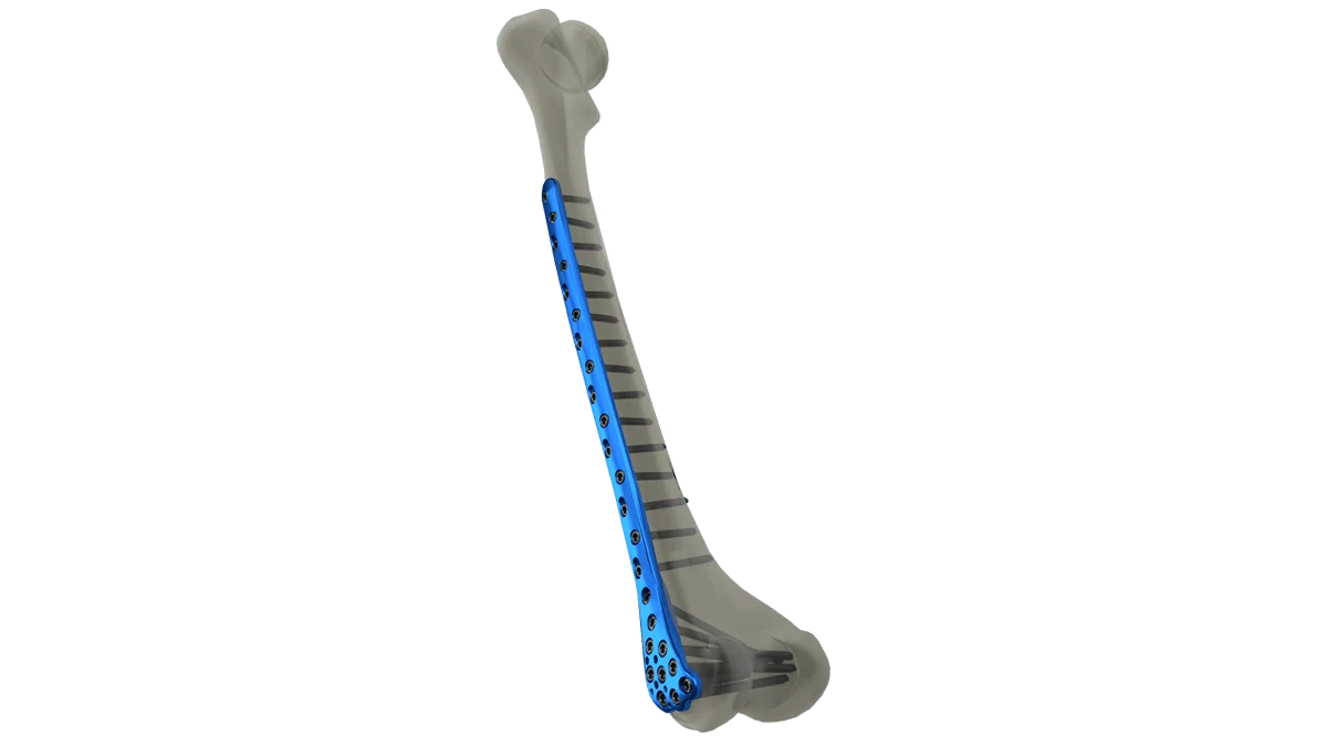 Distal Femur Locking Plate — view 1