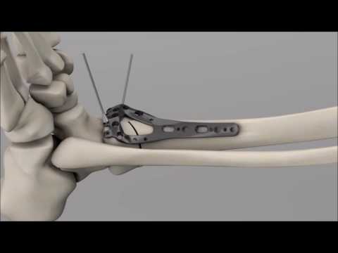 STEP™ Ankle Fracture Plating System - Anterior Plate