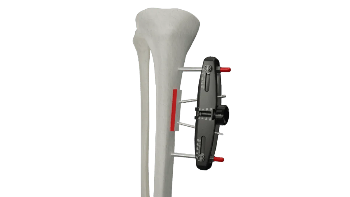 MicroLift® — view 1