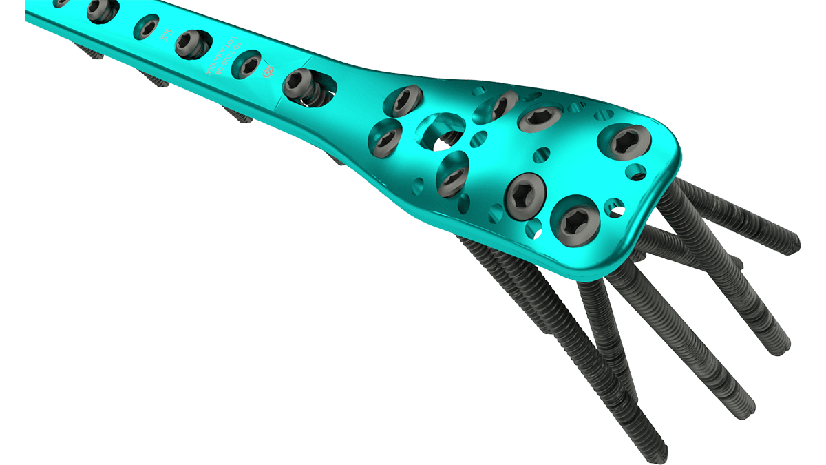Proximal Humerus Locking Plate — view 1