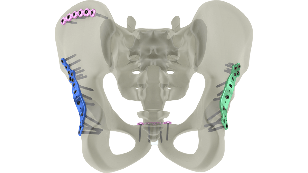 Pelvic and Acetabular Plates — view 1