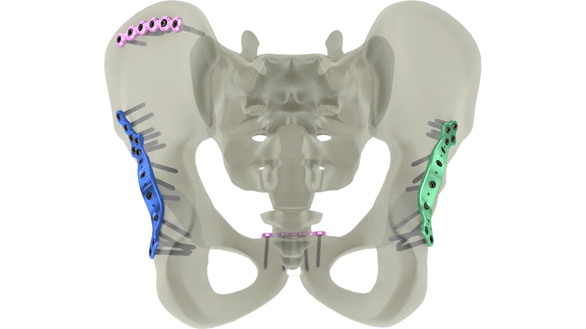Pelvic and Acetabular Plates — view 1