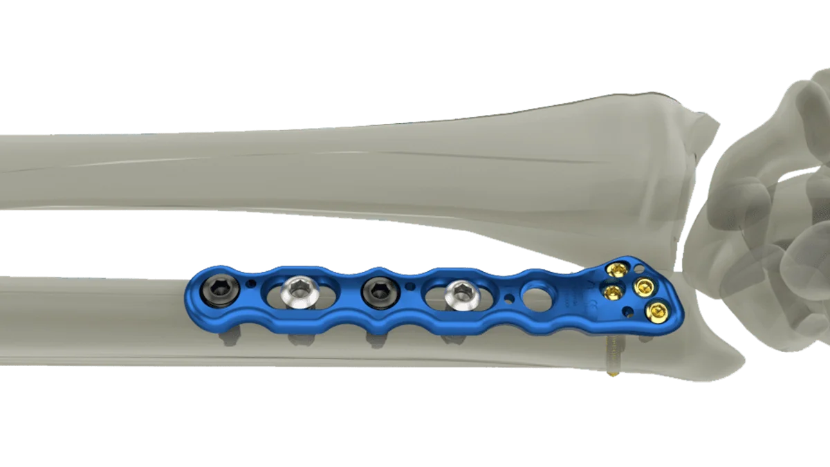 Wrist Plating System — view 1