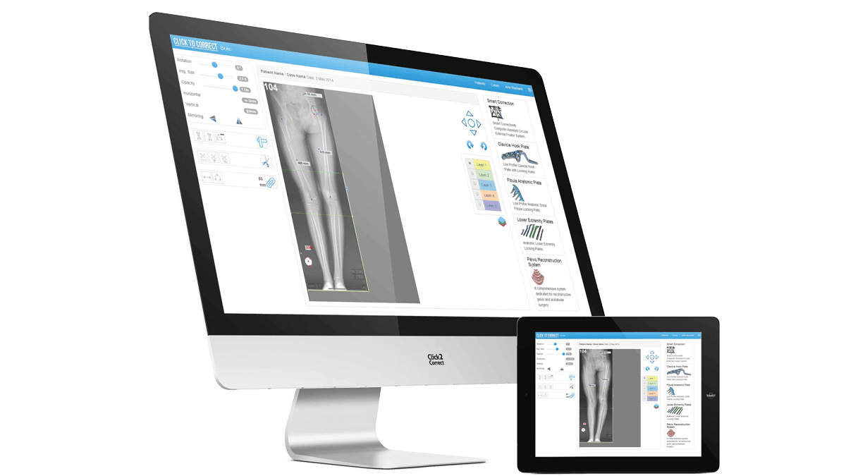 Smart Fixator - PreOperative Planning Software — view 1