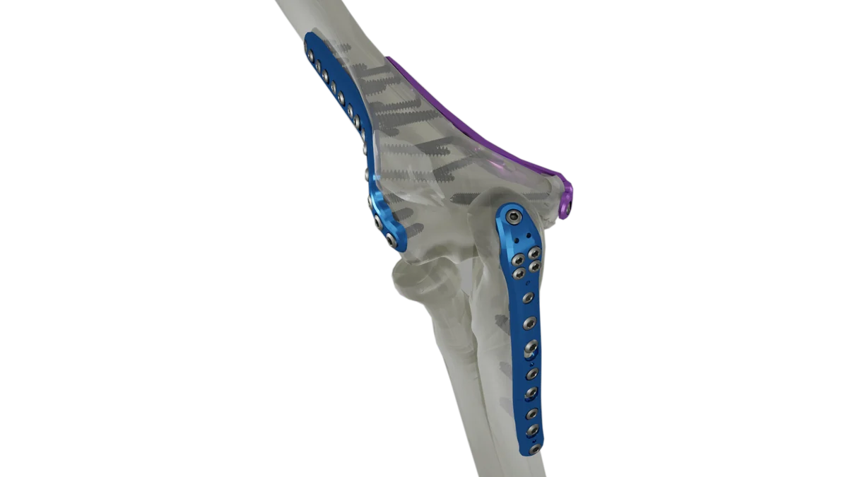 Anatomic Elbow Plates — view 1