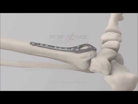 STEP™ Ankle Fracture Plating System - Medial Spoon Plate