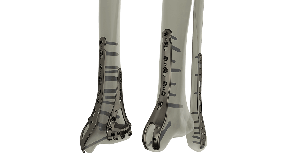 STEP Ankle Fracture Plating System — view 1
