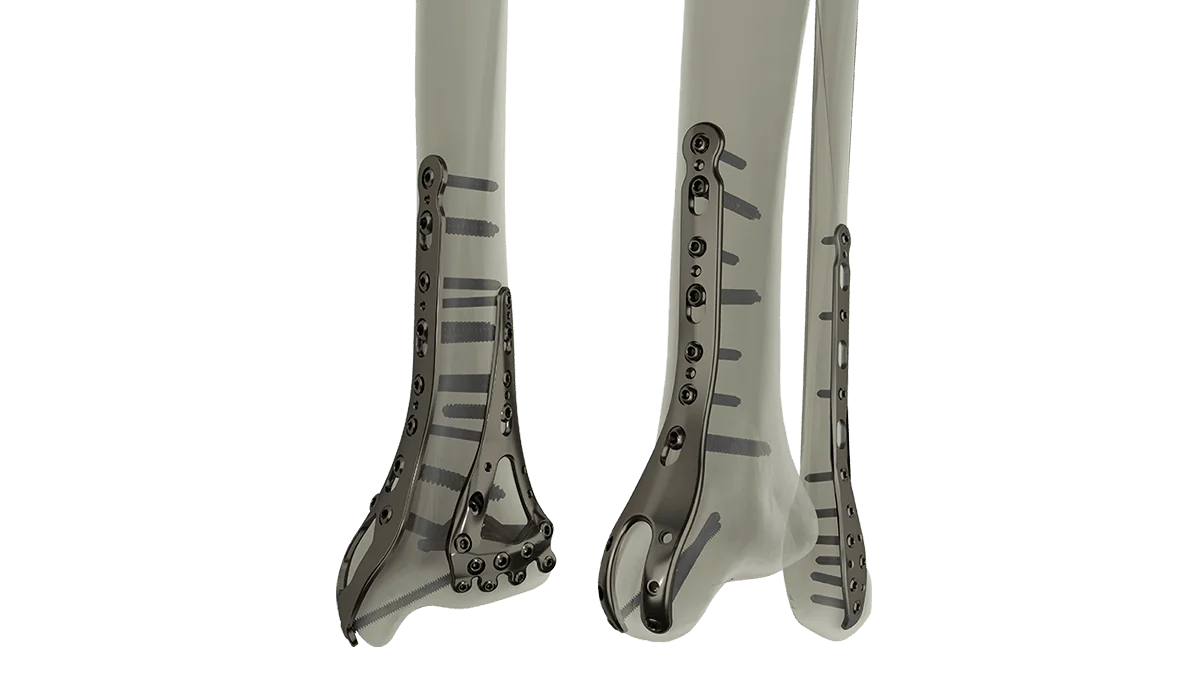 STEP Ankle Fracture Plating System — view 1