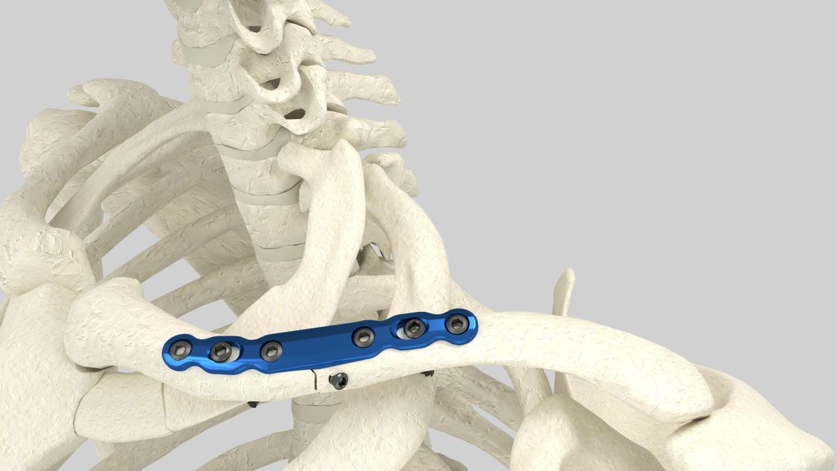 Clavicle Plating System — view 1