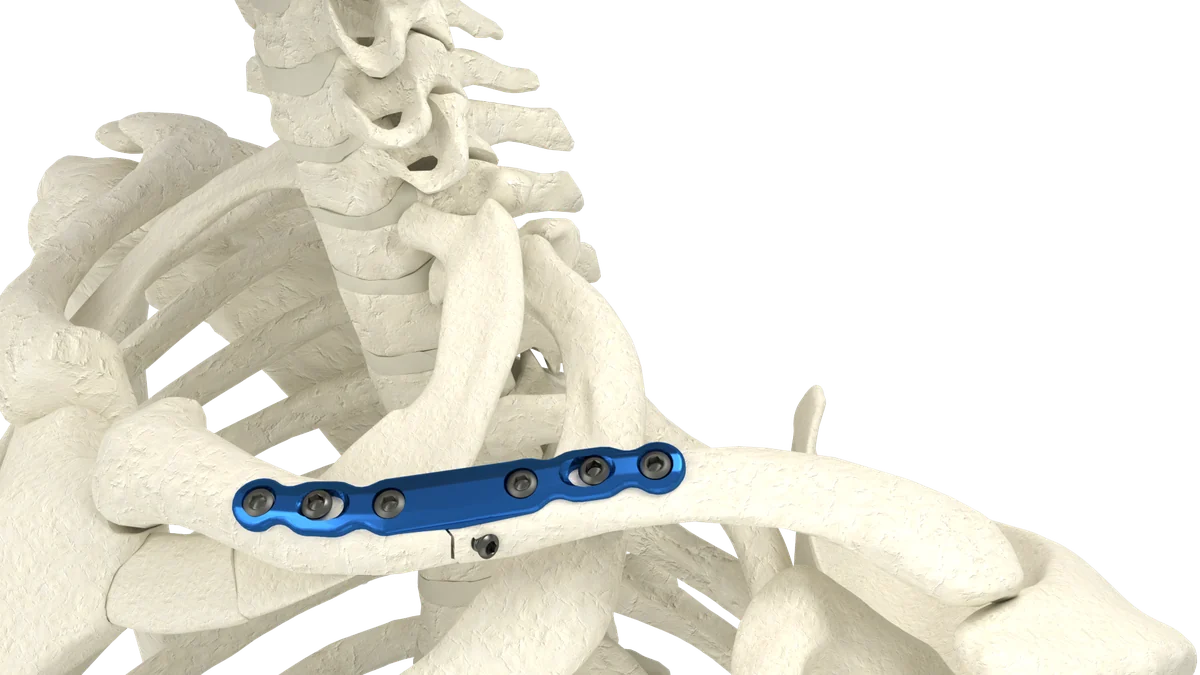 Clavicle Plating System — view 1