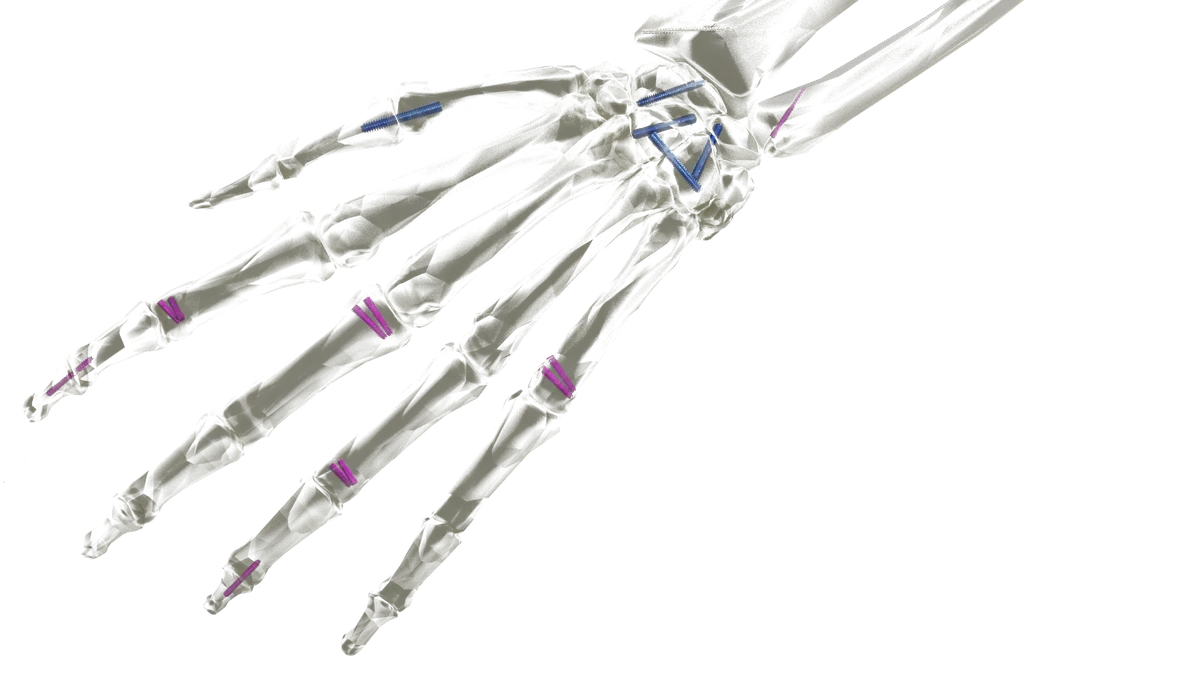 Headless Compression Screw System — view 1