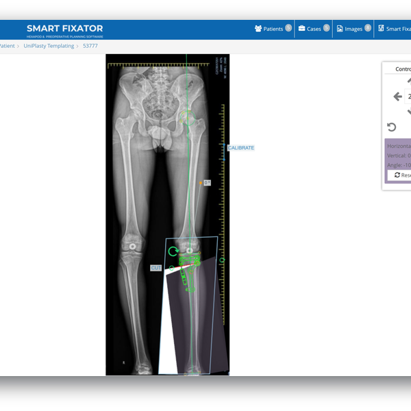 Smart Fixator® – Preoperative Planning and Templating