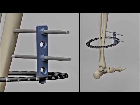 Easy Lock™ Screw Clamp