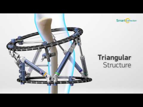 Smart Correction Hexapod Fixator