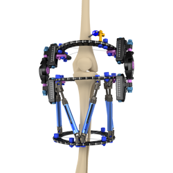 EXTERNAL FIXATORS - Response Ortho